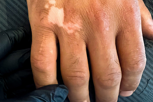 dermo pigmentation vitiligo