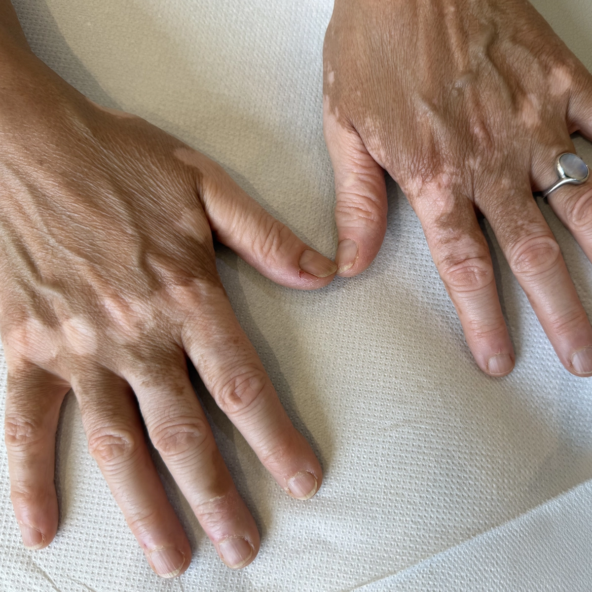 clinicaderm • Stéphanie Sportes | dermopigmentation réparatrice duvitiligo