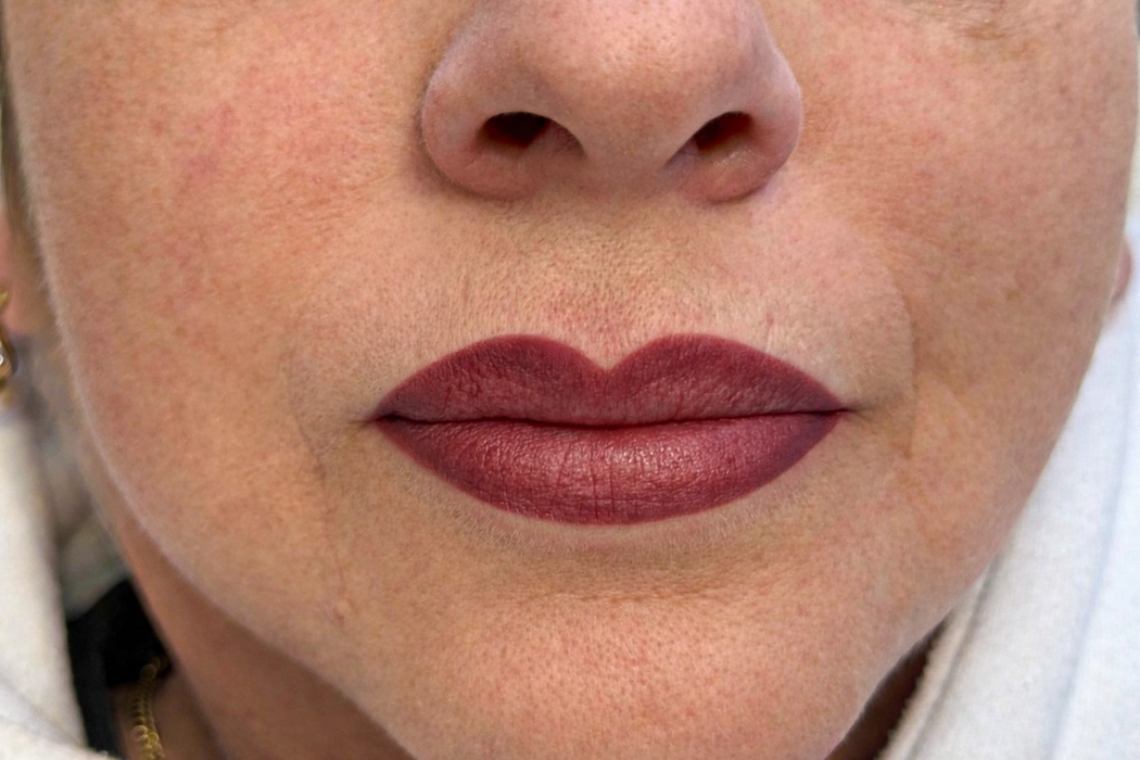 Clinicaderm • Stéphanie Sportes |Lèvres – correction et restauration du contour