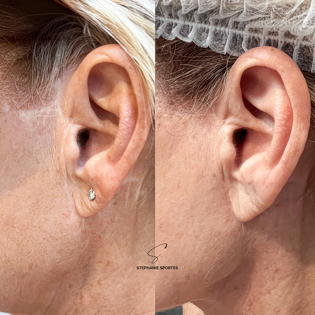 Clinicaderm • Stéphanie Sportes | cicatrices et séquelles cutanées