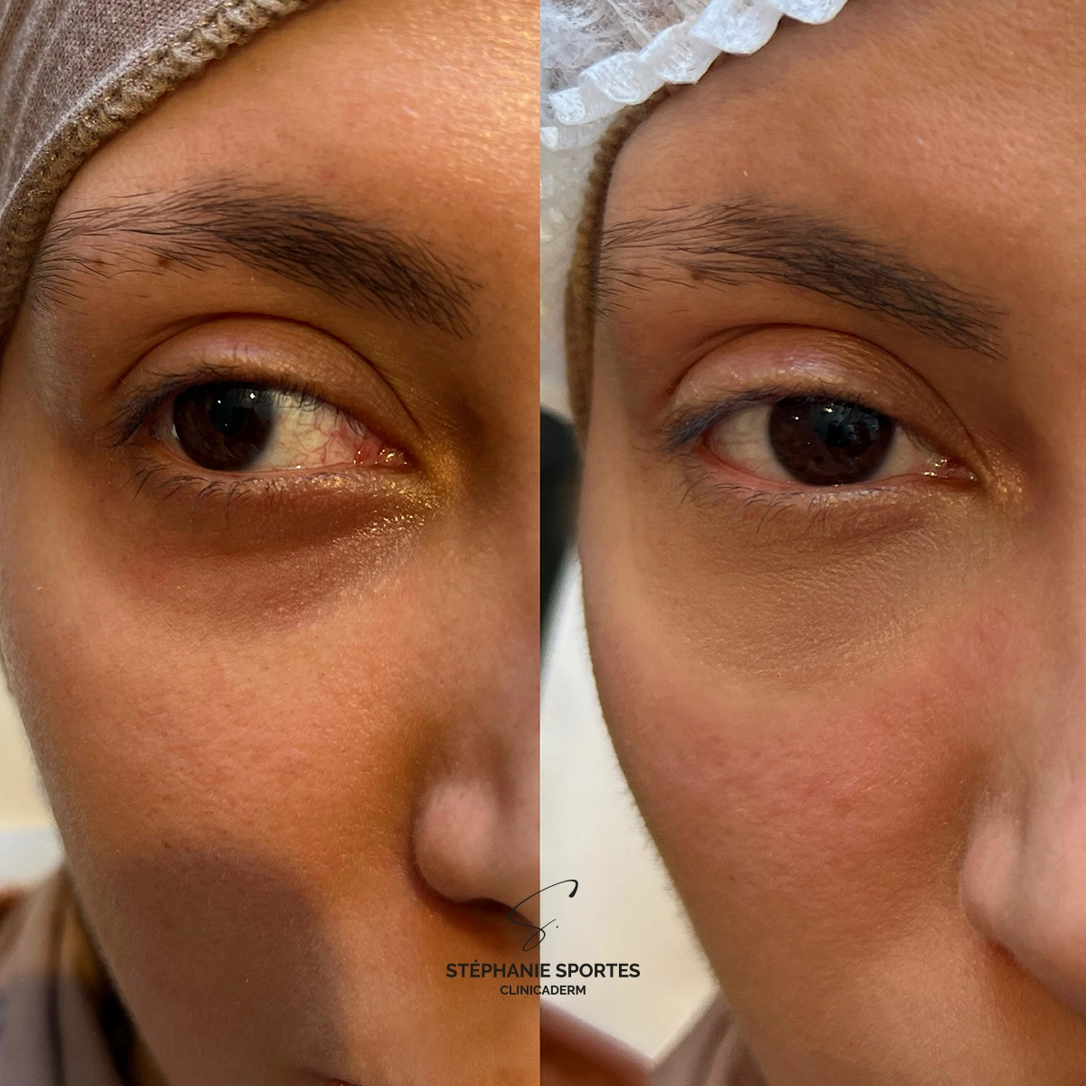 Clinicaderm • Stéphanie Sportes | dermopigmentation des cernes