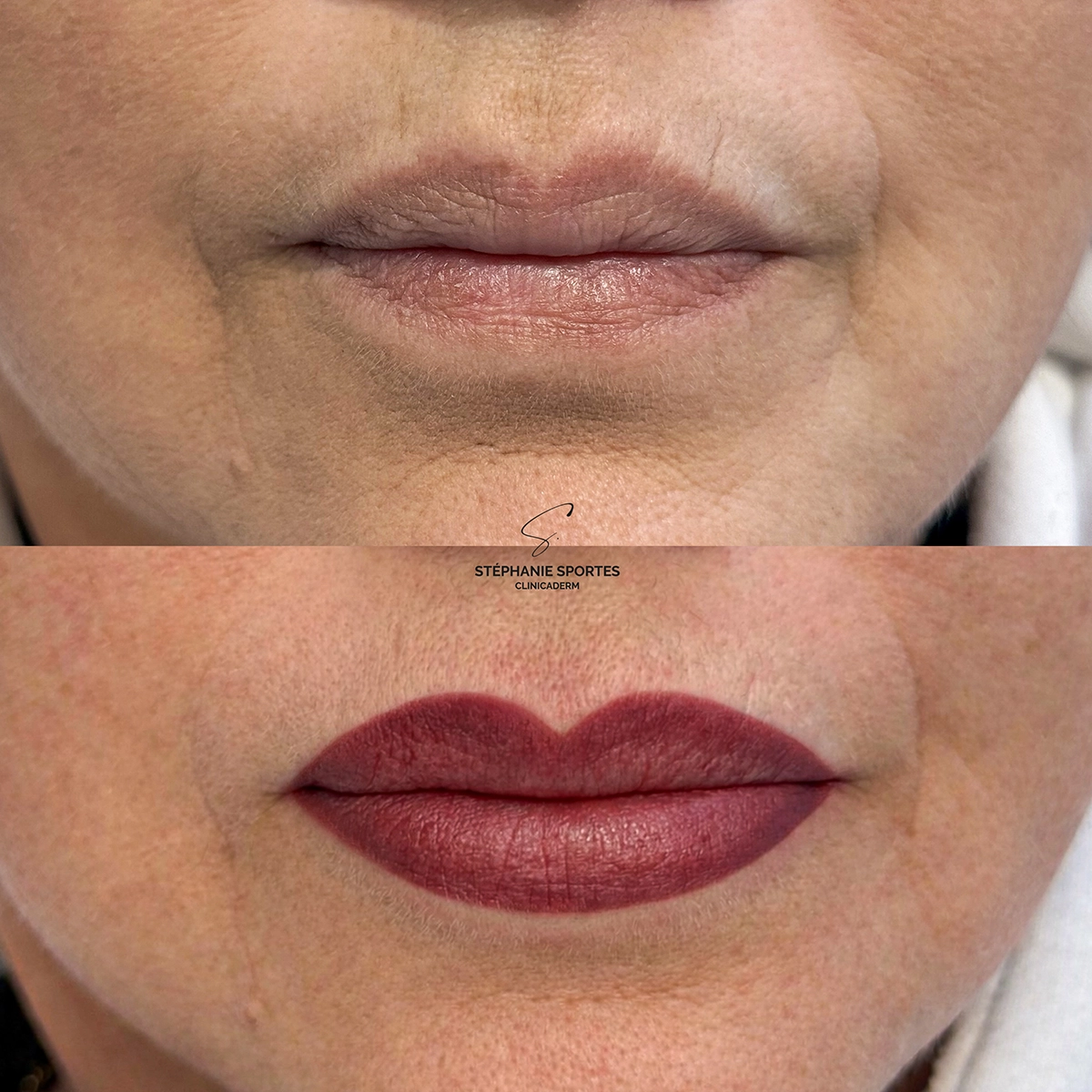 Clinicaderm • Stéphnaie Sportes | lèvres - correction et restauration du contour